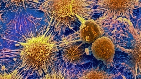 علماء: السرطان سيصبح امرا اعتياديا مؤسفا في المستقبل